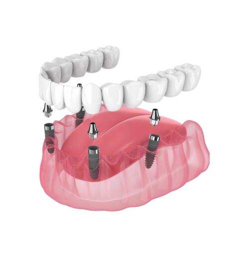 Восстановление всех зубов на 4 имплантах Neodent