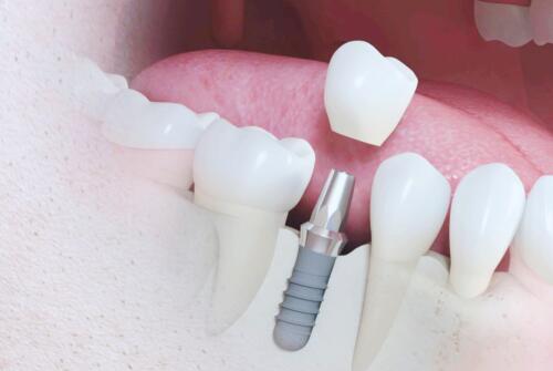 Имплантация Osstem с циркониевой коронкой